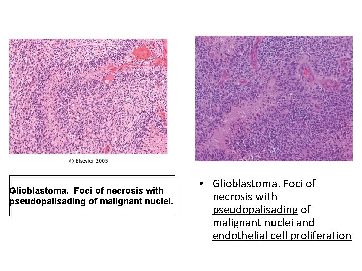 Glioblastoma. Foci of necrosis with pseudopalisading of malignant nuclei. • Glioblastoma. Foci of necrosis