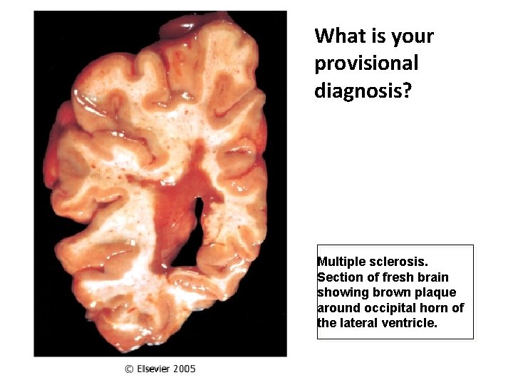 What is your provisional diagnosis? Multiple sclerosis. Section of fresh brain showing brown plaque