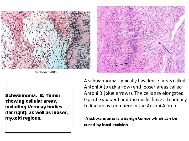 Schwannoma. B, Tumor showing cellular areas, including Verocay bodies (far right), as well as