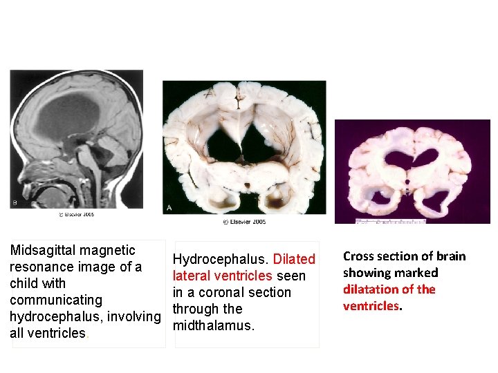 Midsagittal magnetic resonance image of a child with communicating hydrocephalus, involving all ventricles. Hydrocephalus.