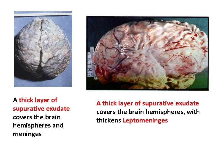 A thick layer of supurative exudate covers the brain hemispheres and meninges A thick