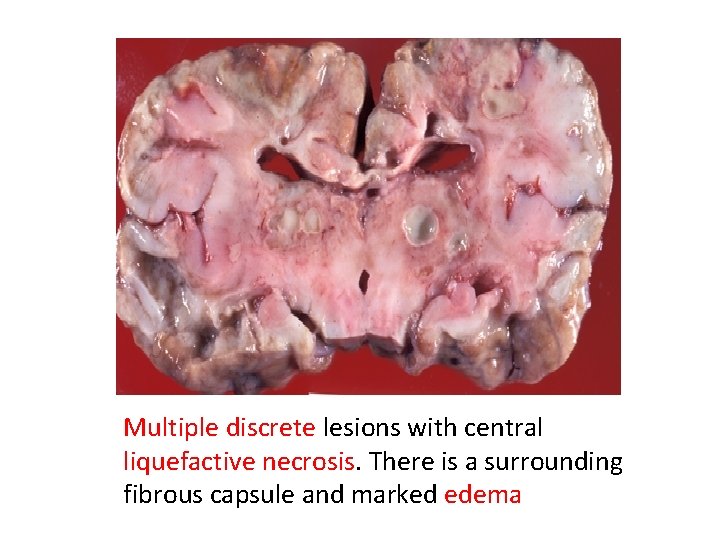 Multiple discrete lesions with central liquefactive necrosis. There is a surrounding fibrous capsule and