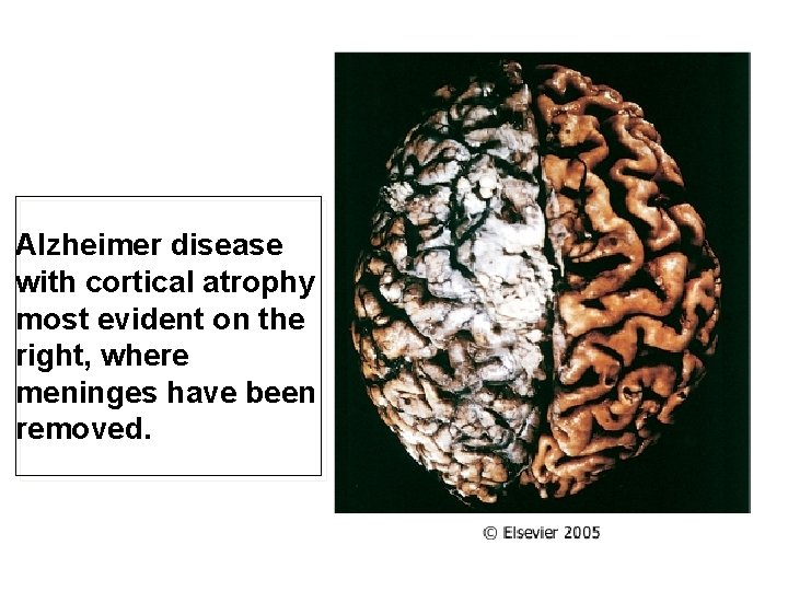 Alzheimer disease with cortical atrophy most evident on the right, where meninges have been