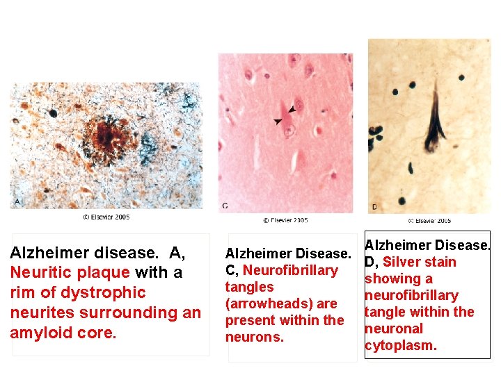 Alzheimer disease. A, Neuritic plaque with a rim of dystrophic neurites surrounding an amyloid