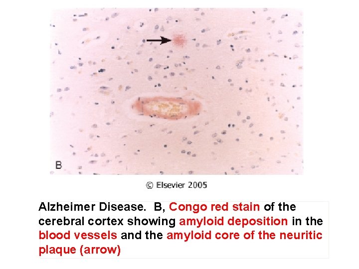 Alzheimer Disease. B, Congo red stain of the cerebral cortex showing amyloid deposition in
