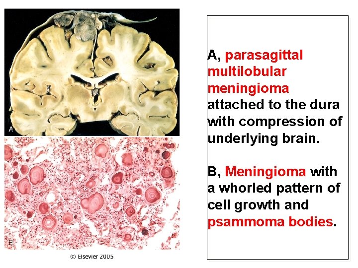 A, parasagittal multilobular meningioma attached to the dura with compression of underlying brain. B,