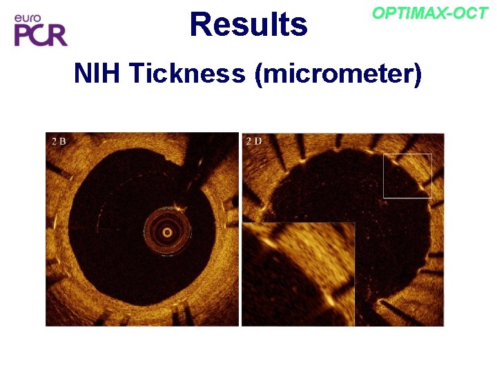 Results OPTIMAX-OCT NIH Tickness (micrometer) 