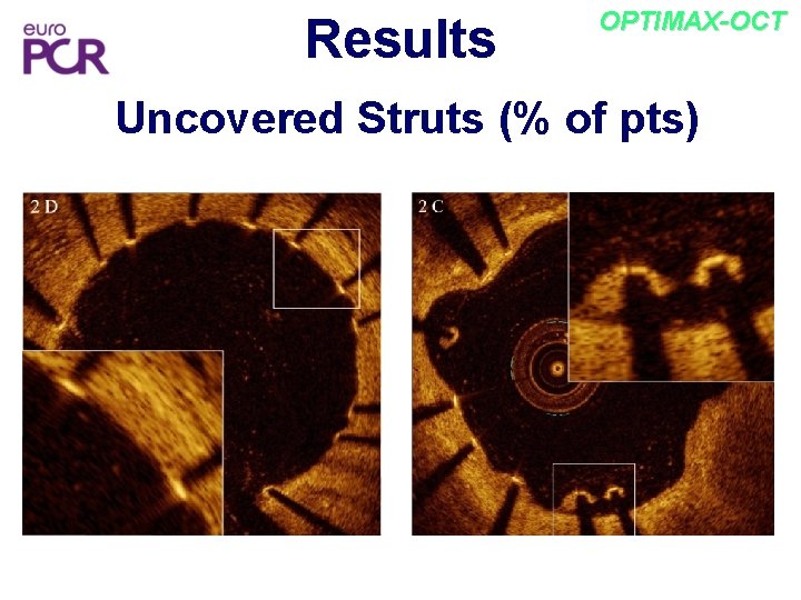 Results OPTIMAX-OCT Uncovered Struts (% of pts) 