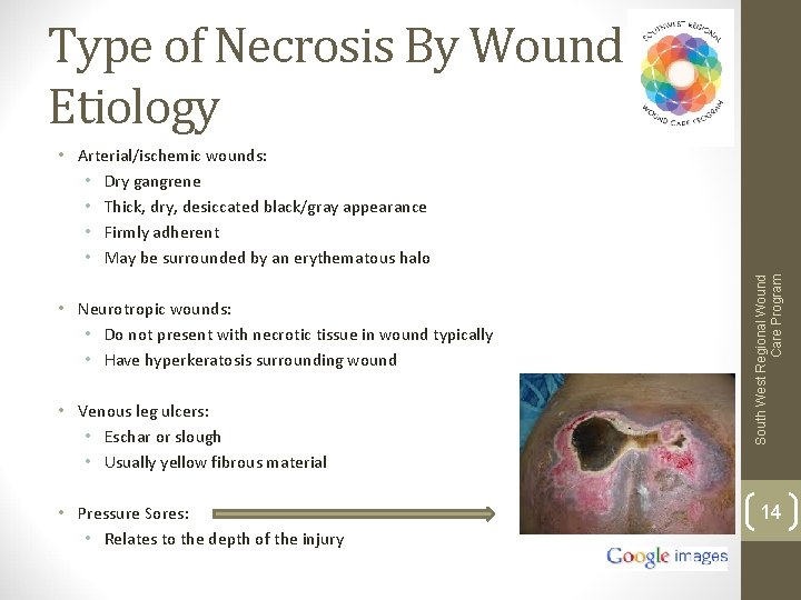 Type of Necrosis By Wound Etiology • Neurotropic wounds: • Do not present with