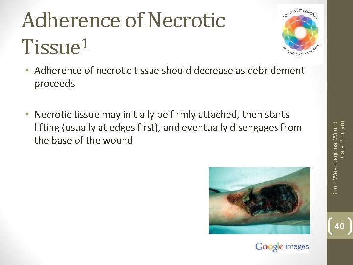 Adherence of Necrotic Tissue 1 • Necrotic tissue may initially be firmly attached, then