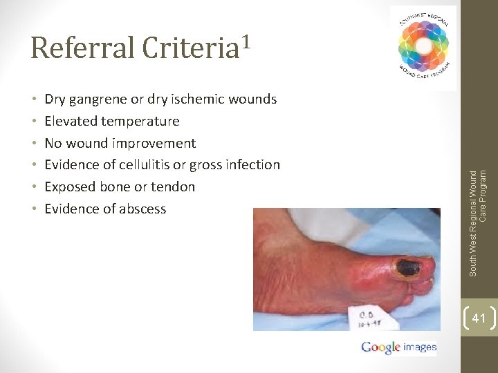  • • • Dry gangrene or dry ischemic wounds Elevated temperature No wound