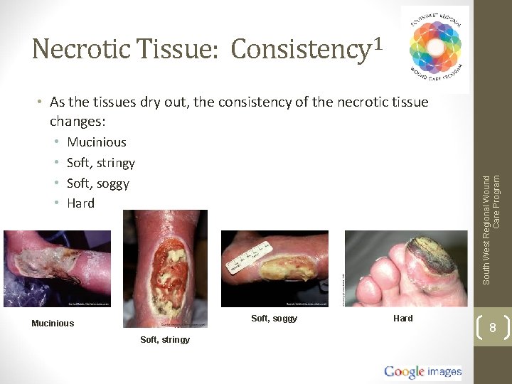 Necrotic Tissue: Consistency 1 • As the tissues dry out, the consistency of the