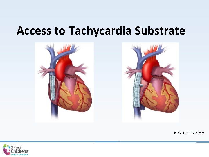 Access to Tachycardia Substrate Kutty et al. , Heart, 2015 