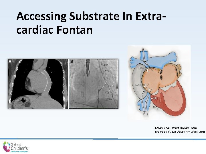 Accessing Substrate In Extracardiac Fontan Moore et al. , Heart Rhythm, 2016 Moore et