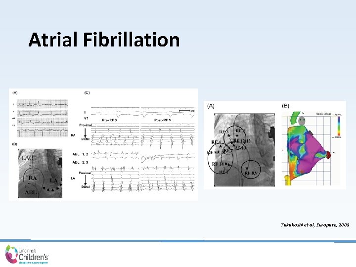 Atrial Fibrillation Takahashi et al, Europace, 2008 