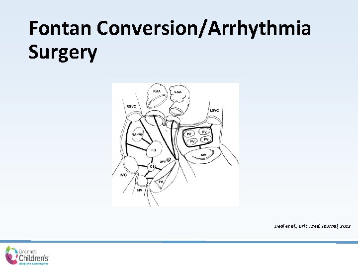 Fontan Conversion/Arrhythmia Surgery Deal et al. , Brit. Med. Journal, 2012 