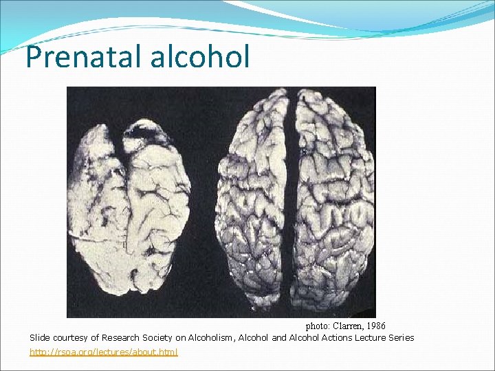 Prenatal alcohol photo: Clarren, 1986 Slide courtesy of Research Society on Alcoholism, Alcohol and