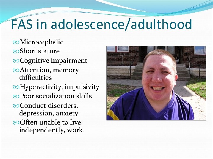 FAS in adolescence/adulthood Microcephalic Short stature Cognitive impairment Attention, memory difficulties Hyperactivity, impulsivity Poor