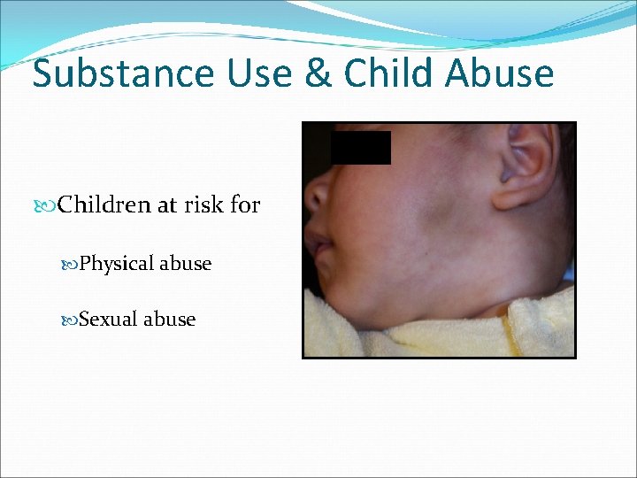 Substance Use & Child Abuse Children at risk for Physical abuse Sexual abuse 