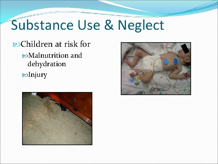Substance Use & Neglect Children at risk for Malnutrition and dehydration Injury 
