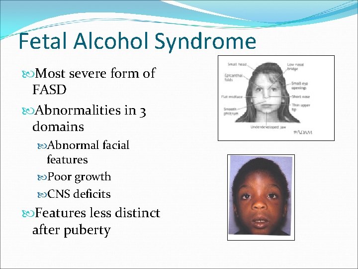 Fetal Alcohol Syndrome Most severe form of FASD Abnormalities in 3 domains Abnormal facial