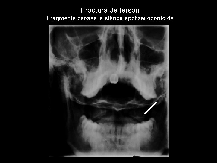 Fractură Jefferson Fragmente osoase la stânga apofizei odontoide 