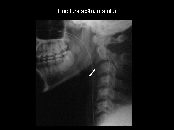 Fractura spânzuratului 