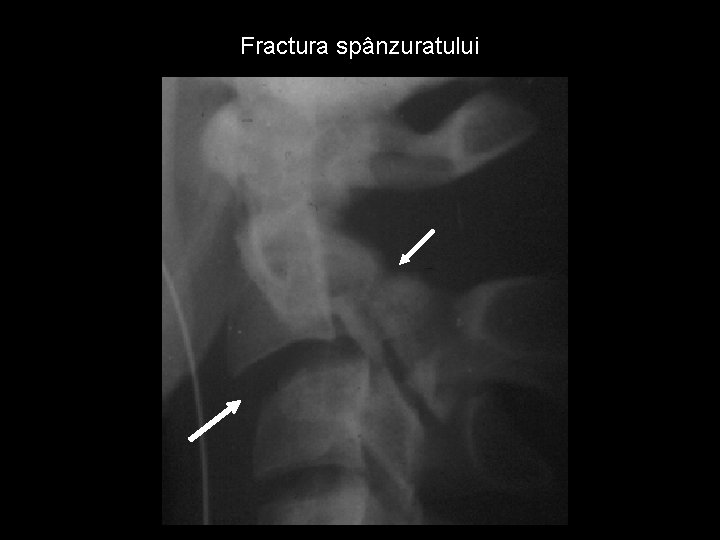 Fractura spânzuratului 