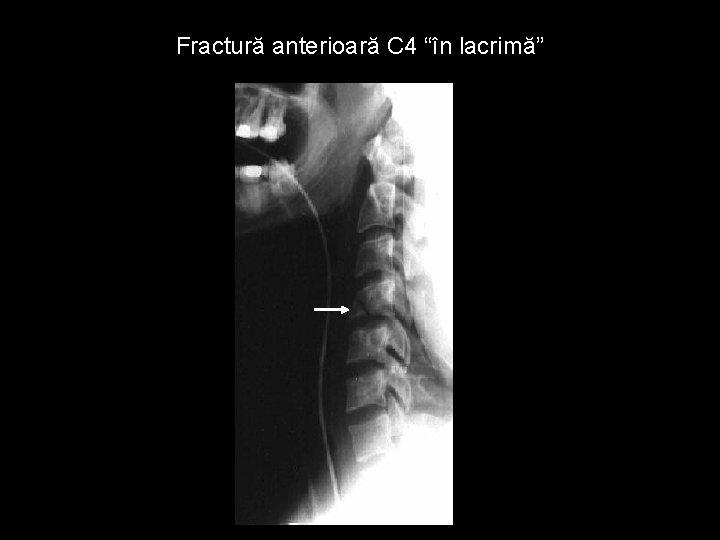 Fractură anterioară C 4 “în lacrimă” 