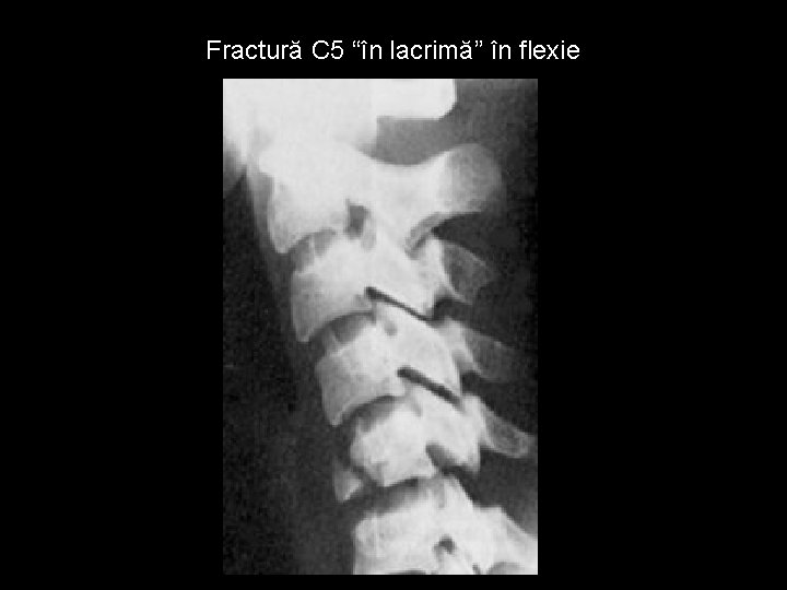 Fractură C 5 “în lacrimă” în flexie 