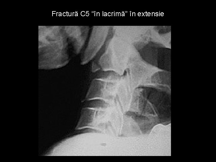 Fractură C 5 “în lacrimă” în extensie 