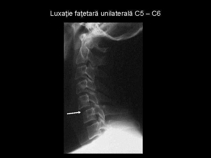 Luxaţie faţetară unilaterală C 5 – C 6 