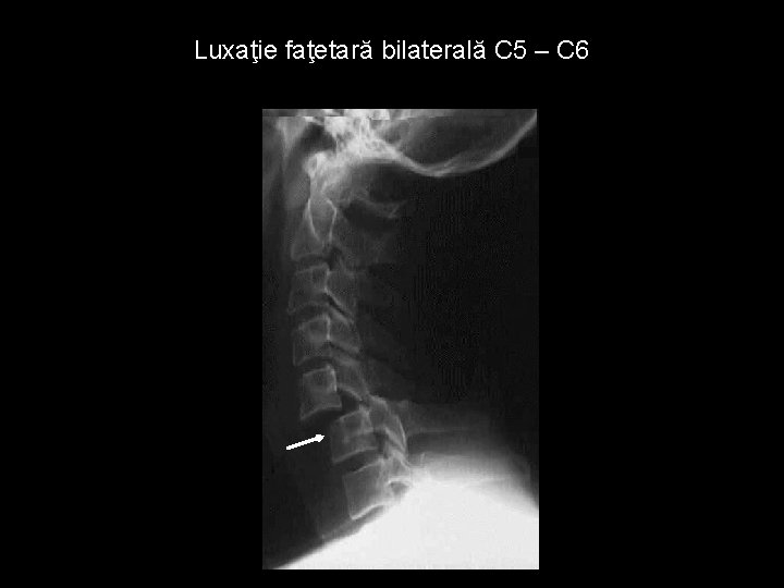 Luxaţie faţetară bilaterală C 5 – C 6 