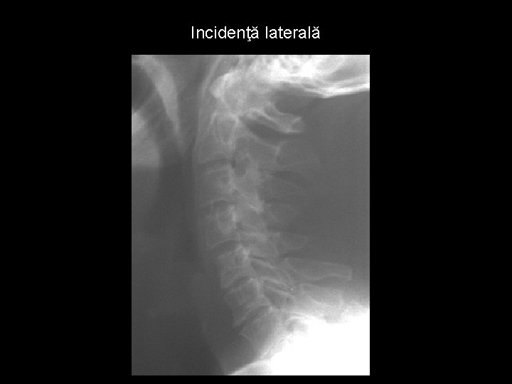 Incidenţă laterală 