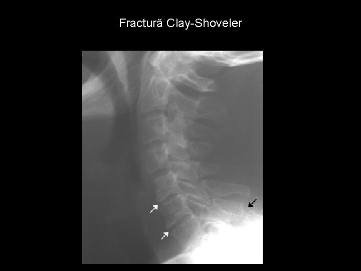 Fractură Clay-Shoveler 