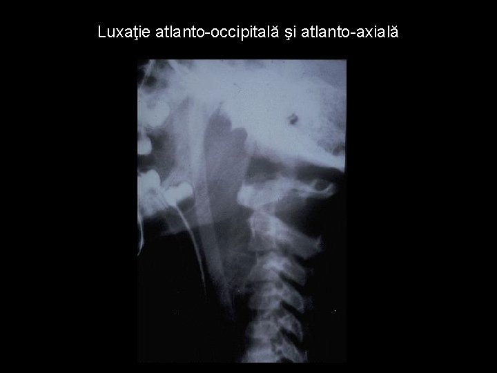 Luxaţie atlanto-occipitală şi atlanto-axială 