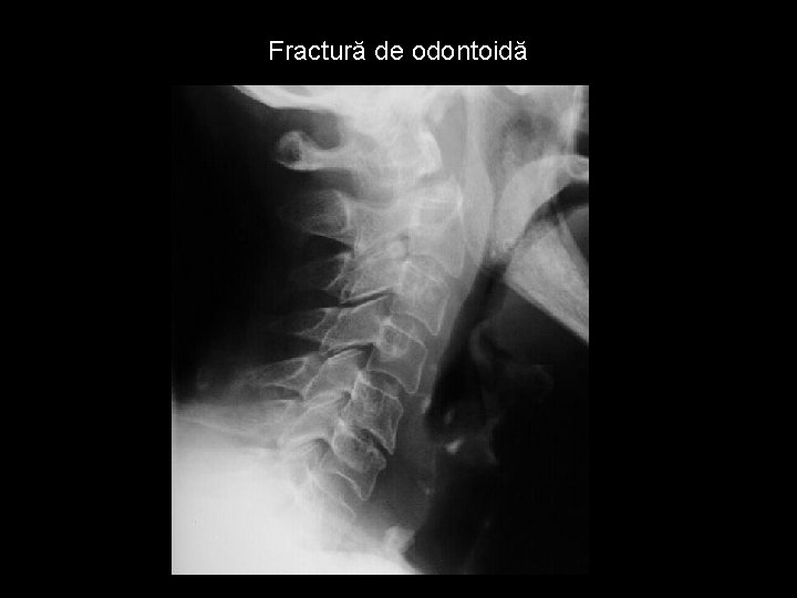 Fractură de odontoidă 