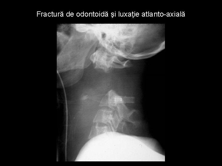 Fractură de odontoidă şi luxaţie atlanto-axială 