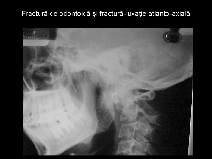 Fractură de odontoidă şi fractură-luxaţie atlanto-axială 