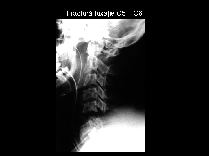 Fractură-luxaţie C 5 – C 6 