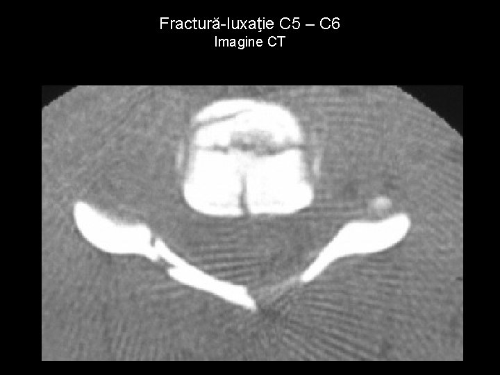 Fractură-luxaţie C 5 – C 6 Imagine CT 