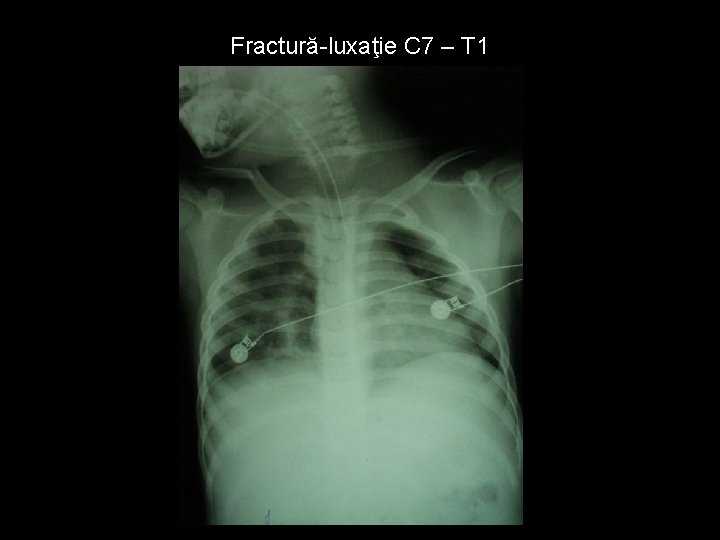 Fractură-luxaţie C 7 – T 1 