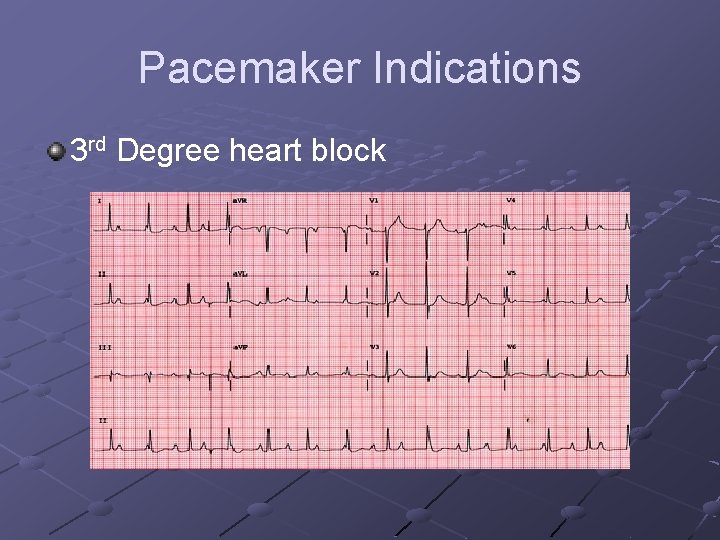 Pacemaker Indications 3 rd Degree heart block 