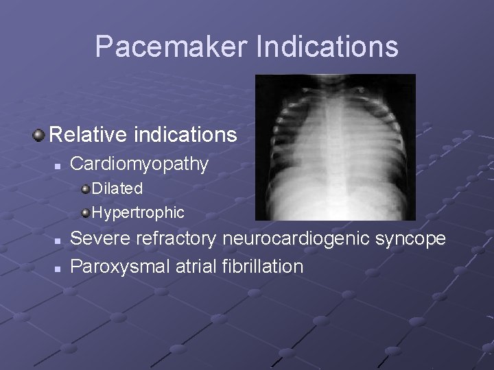 Pacemaker Indications Relative indications n Cardiomyopathy Dilated Hypertrophic n n Severe refractory neurocardiogenic syncope