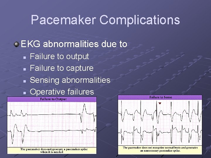 Pacemaker Complications EKG abnormalities due to n n Failure to output Failure to capture