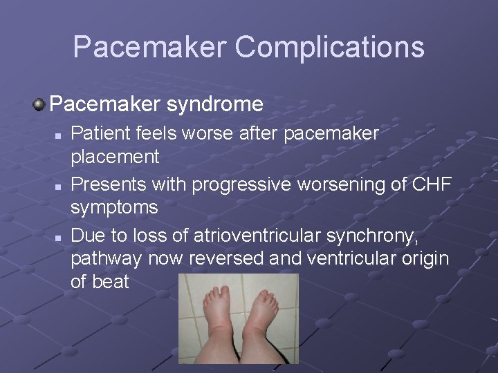 Pacemaker Complications Pacemaker syndrome n n n Patient feels worse after pacemaker placement Presents