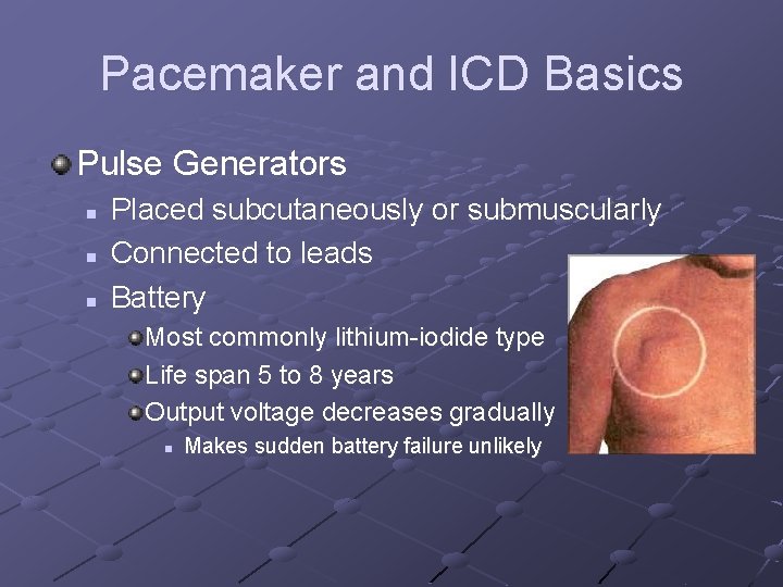 Pacemaker and ICD Basics Pulse Generators n n n Placed subcutaneously or submuscularly Connected