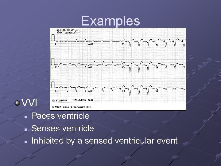 Examples VVI n n n Paces ventricle Senses ventricle Inhibited by a sensed ventricular