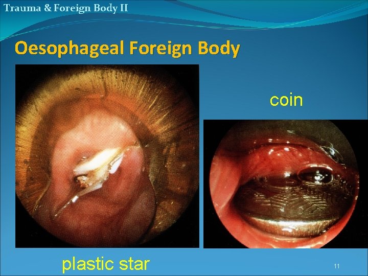 Trauma & Foreign Body II Oesophageal Foreign Body coin plastic star 11 