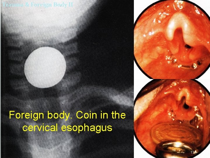 Trauma & Foreign Body II Foreign body. Coin in the cervical esophagus 13 